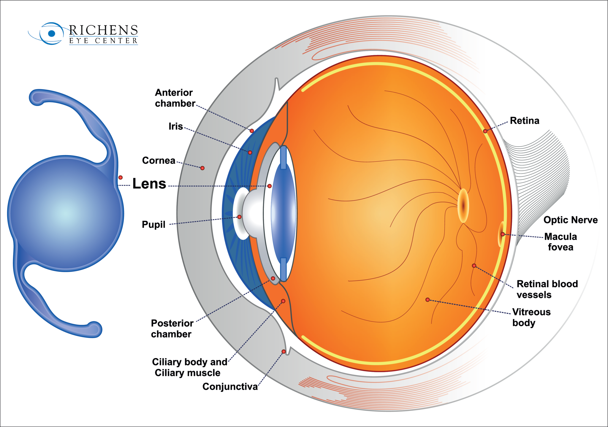 cataract-surgery-merrillville-in-hobart-in-deen-gross-eye-centers