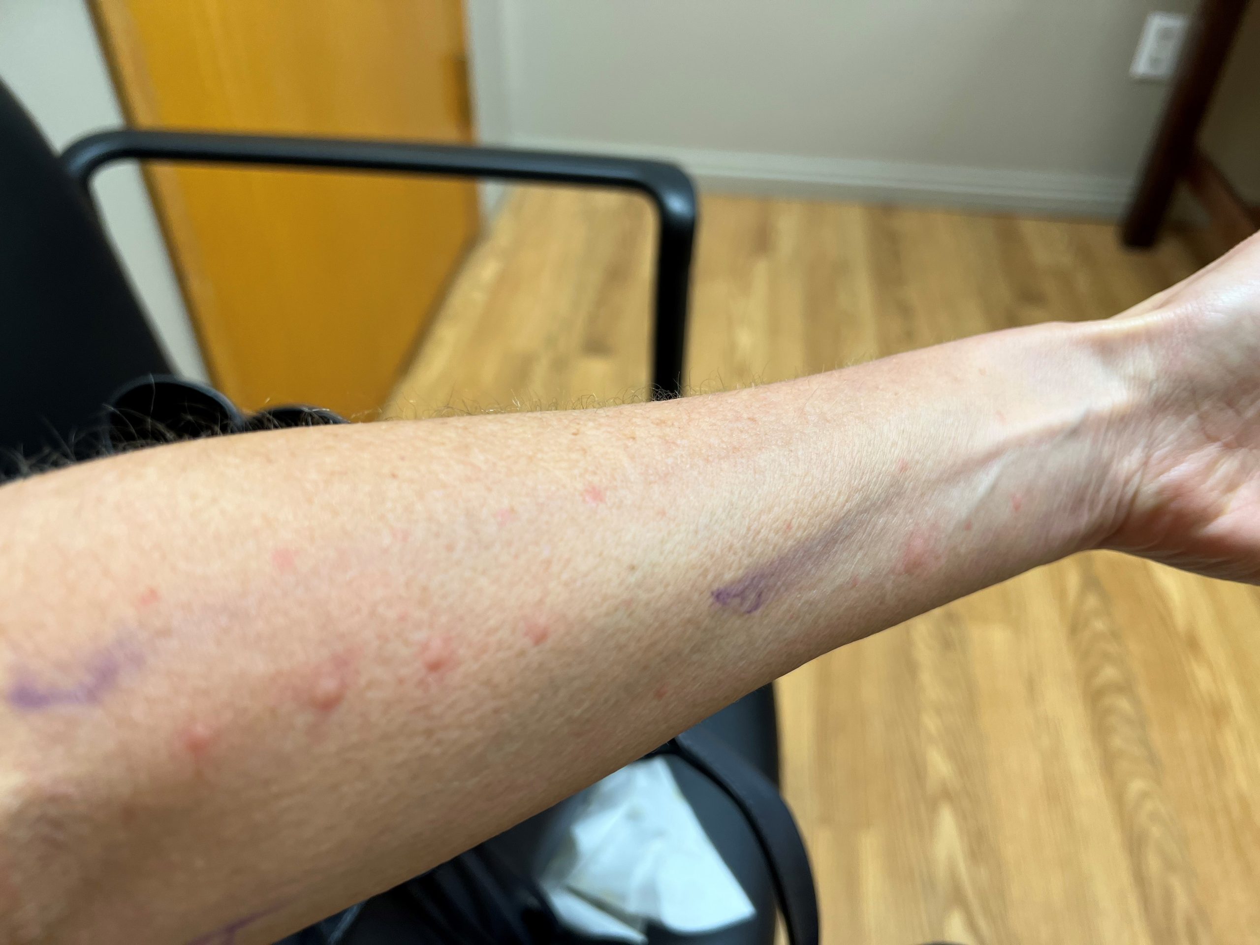 Allergy test reaction welts